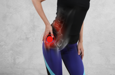 Hip Bursitis: What Is It?